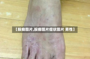 【股癣图片,股癣图片症状图片 男性】