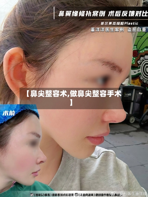 【鼻尖整容术,做鼻尖整容手术】-第2张图片