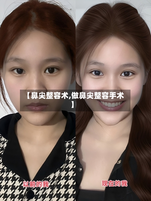 【鼻尖整容术,做鼻尖整容手术】-第3张图片