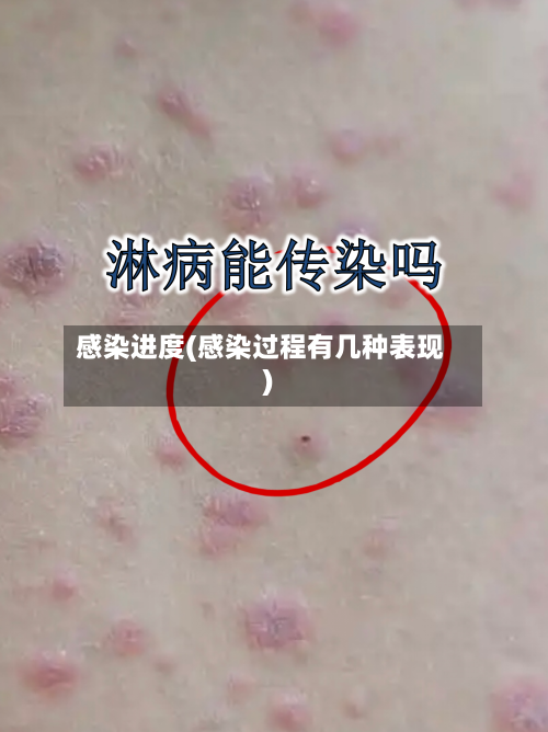 感染进度(感染过程有几种表现)-第1张图片